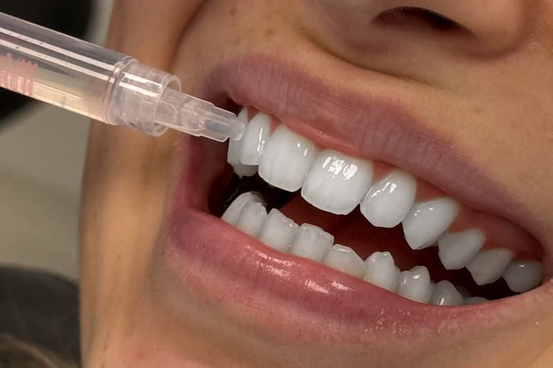 Teeth Whitening Treatment